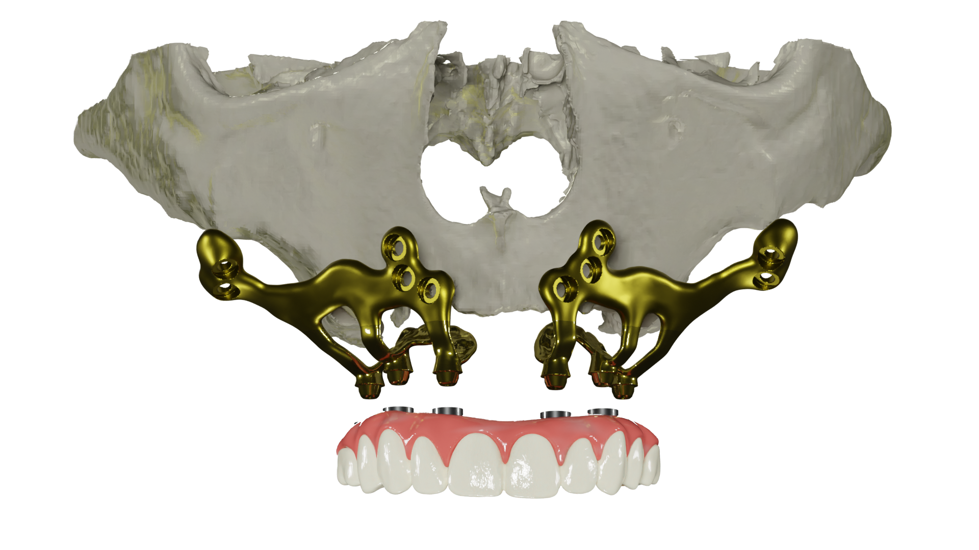 Custommade subperiosteal dental implant